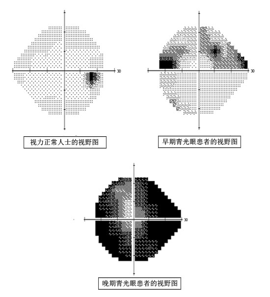 深圳希玛眼科医院青光眼治疗