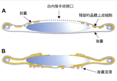 深圳治疗白内障哪里好